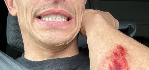 Marc Márquez se cae entrenando dirt track y muestra en redes las secuelas
